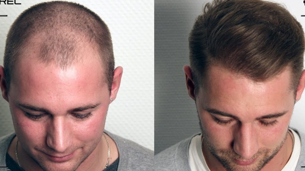 FUE Hair Transplant - Welcome to Aims Clinics By Dr Zameer Abbas